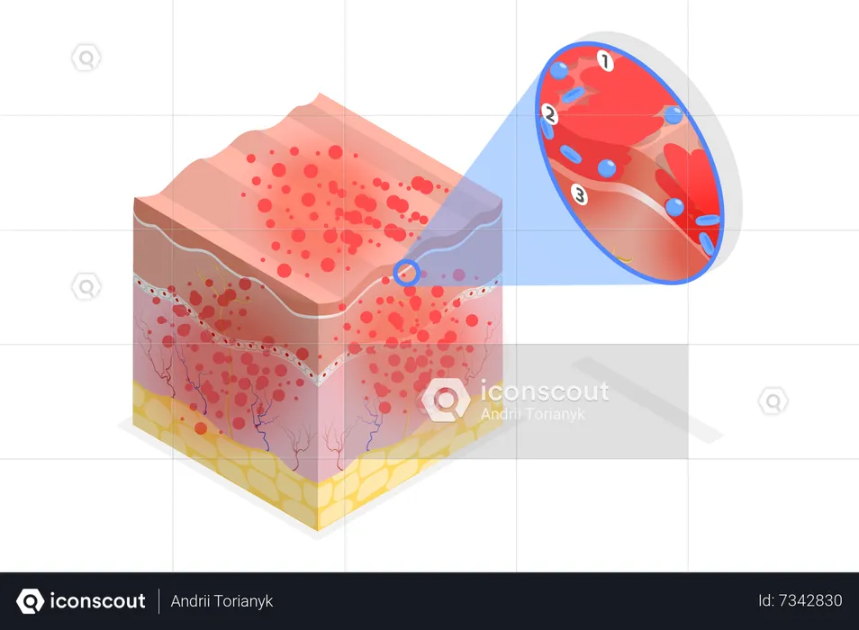 Atopic Dermatitis  Illustration