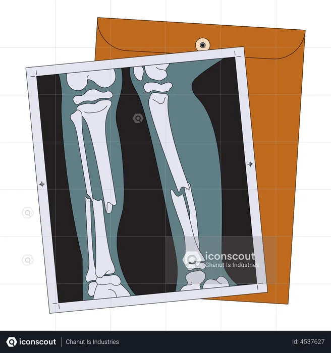 Broken leg x ray  Illustration