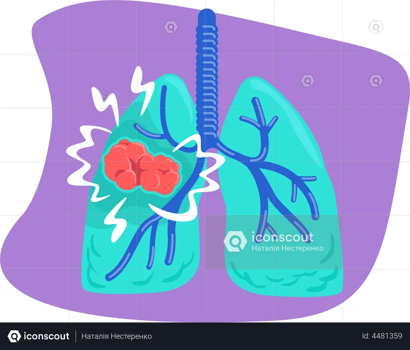 Câncer de pulmão  Ilustração