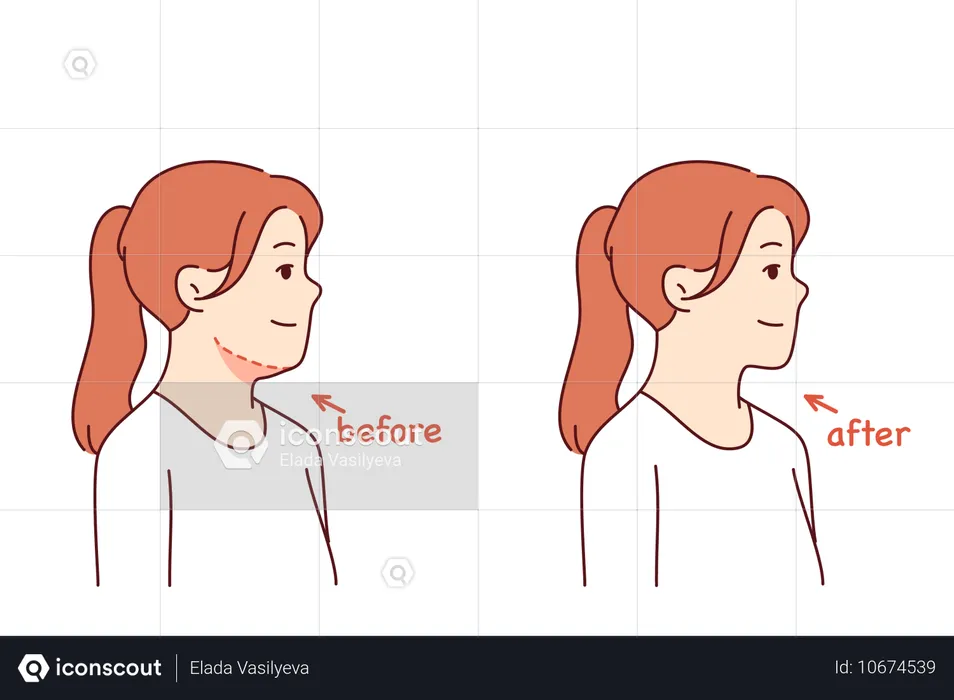 Cirurgia de remoção de queixo duplo em jovem posando antes e depois do procedimento com cosmetologista  Ilustração