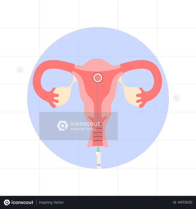 Colocando o embrião no útero da mulher  Ilustração