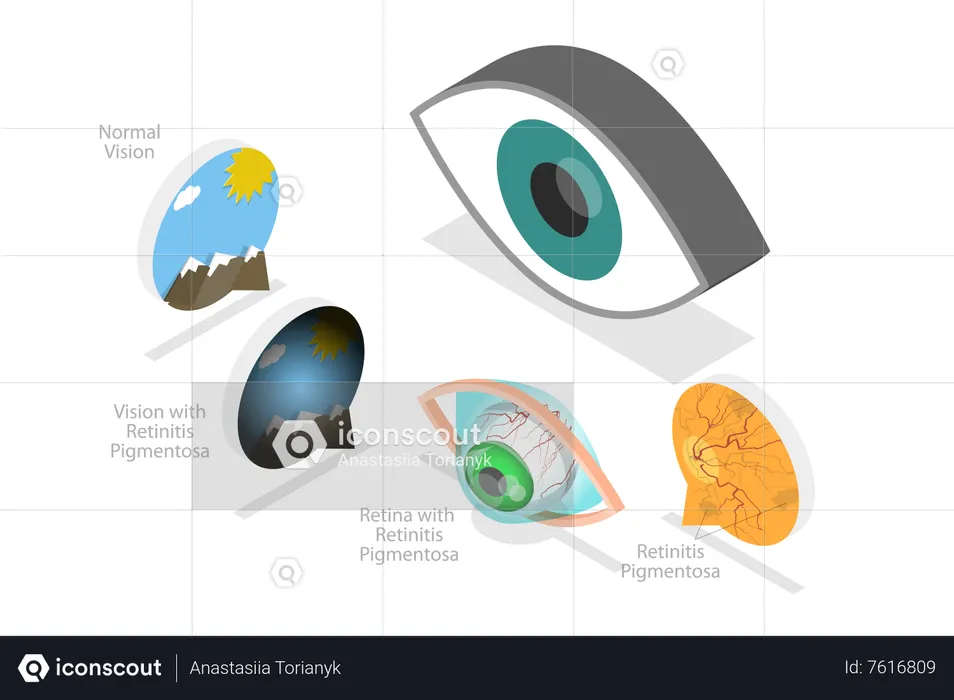 Degeneração Macular Relacionada à Idade  Ilustração