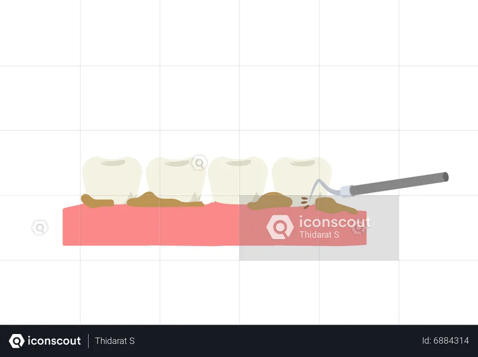 Détartrage des dents à l'aide d'un outil dentaire  Illustration