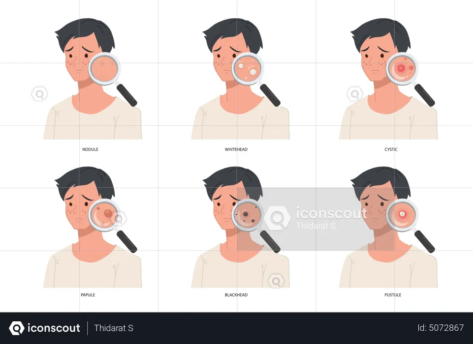 Diferentes tipos de acne grave no rosto masculino  Ilustração