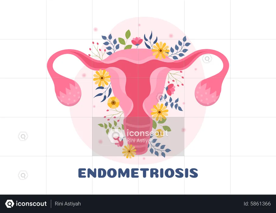 Endométriose  Illustration