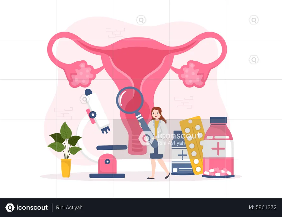 Endometriosis  Illustration