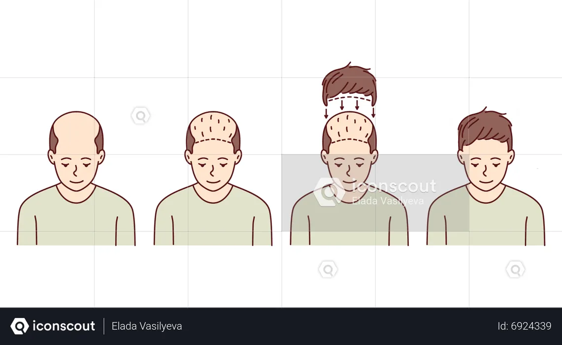 Haartransplantation  Illustration