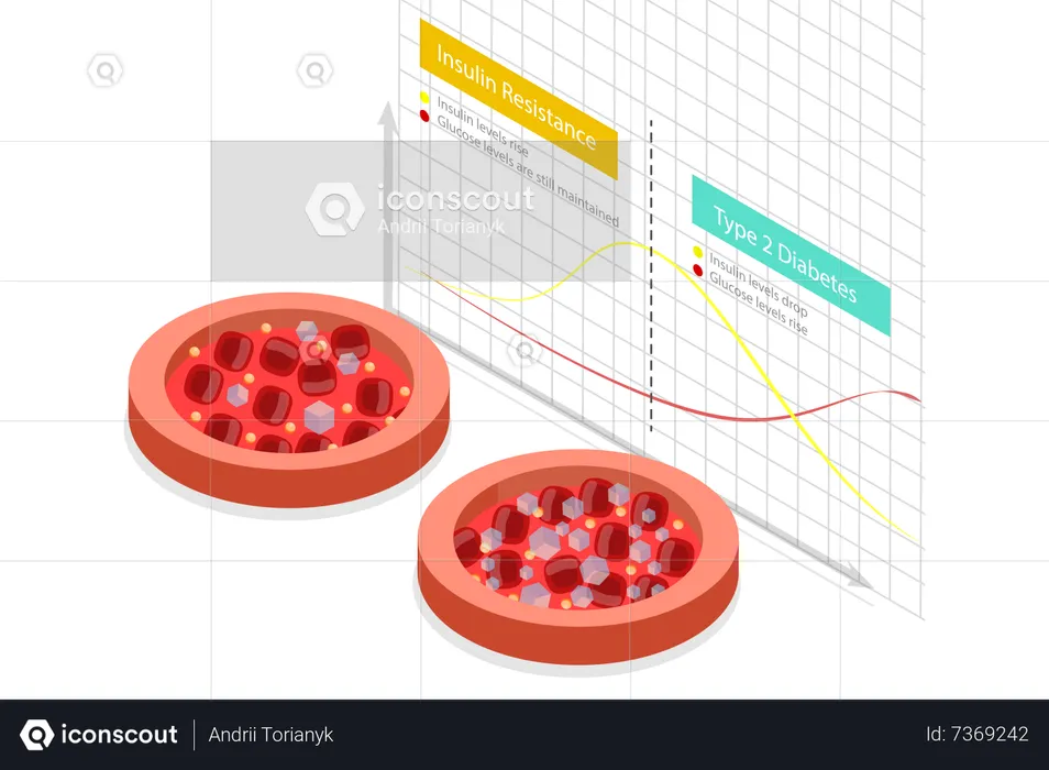 Insulin resistance and Type 2 diabetes chart  Illustration