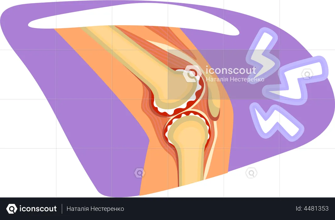 Knee pain  Illustration