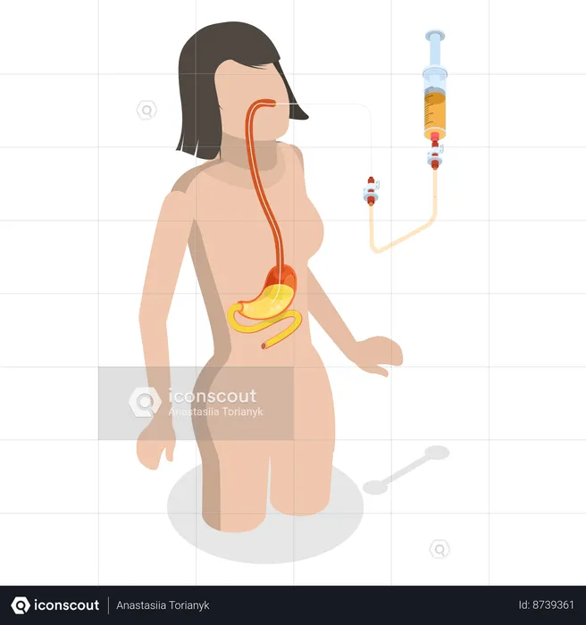 Nasogastric Tube Passed Through Nose to Stomach  Illustration