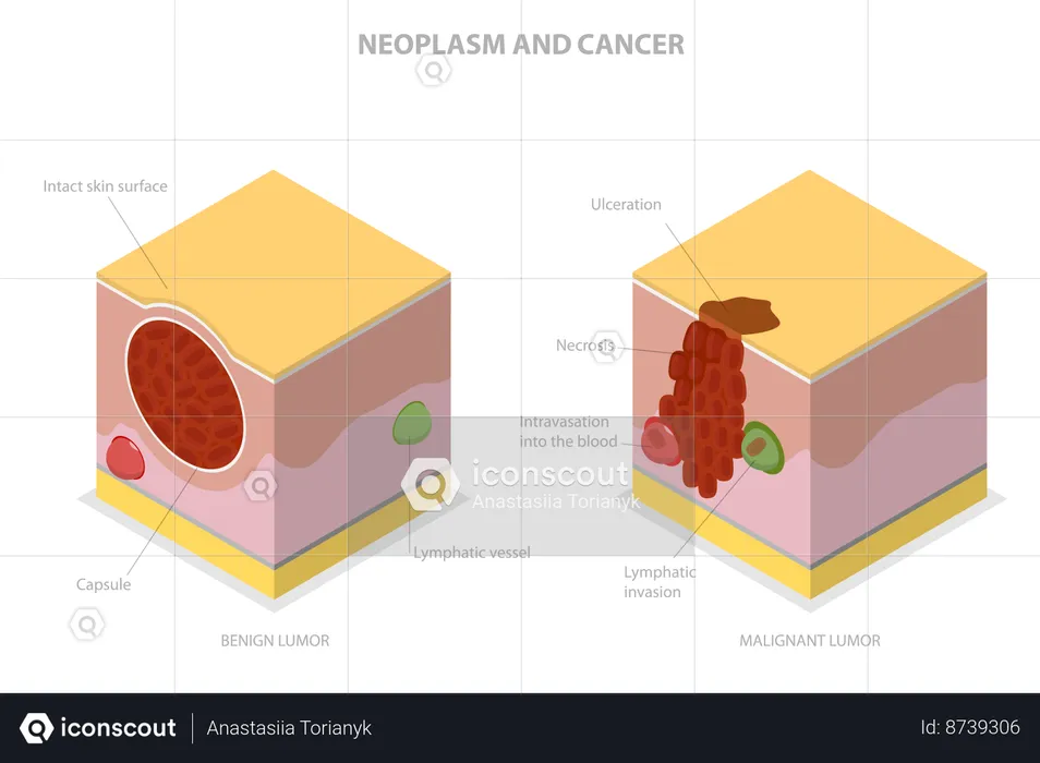 Neoplasm And Cancer  Illustration