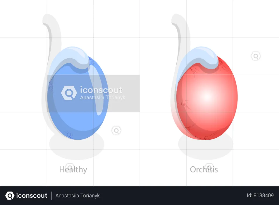 Orchitis and Inflammation of Testes  Illustration