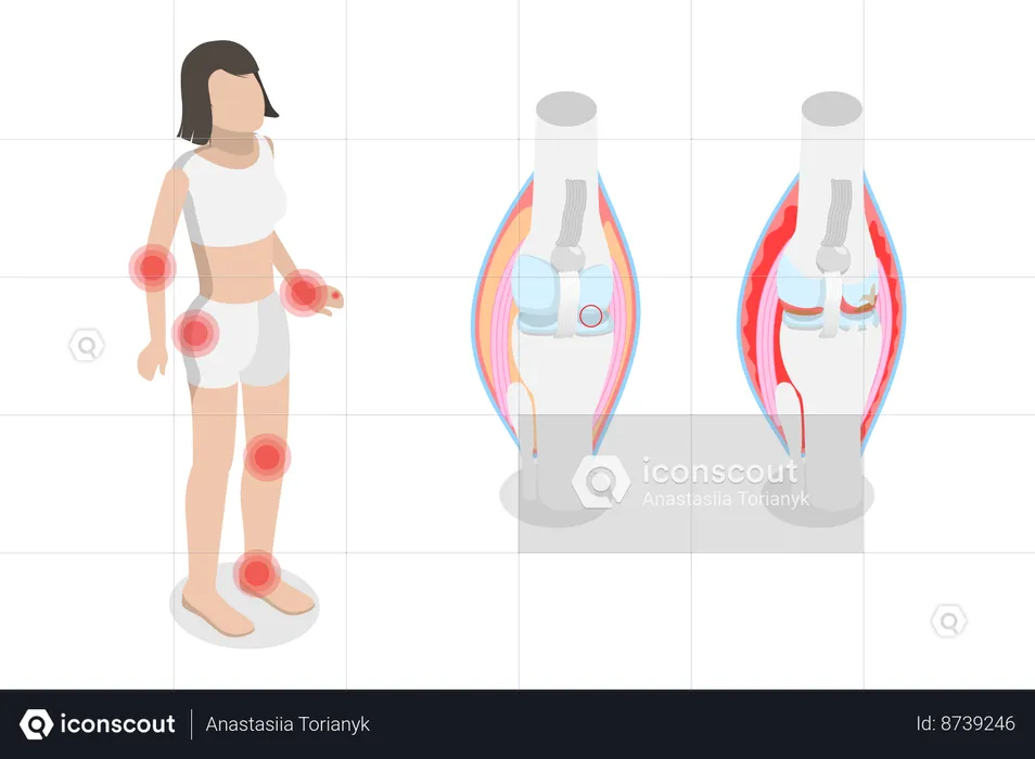 Osteoartritis y artritis reumatoide  Ilustración