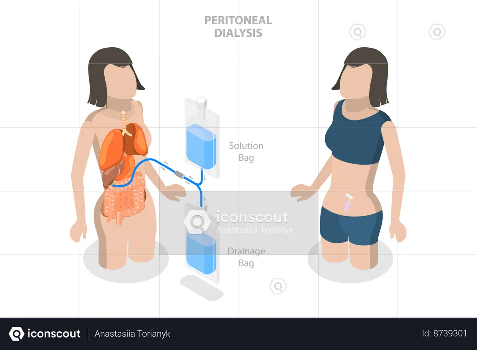 Peritoneal Dialysis  Illustration