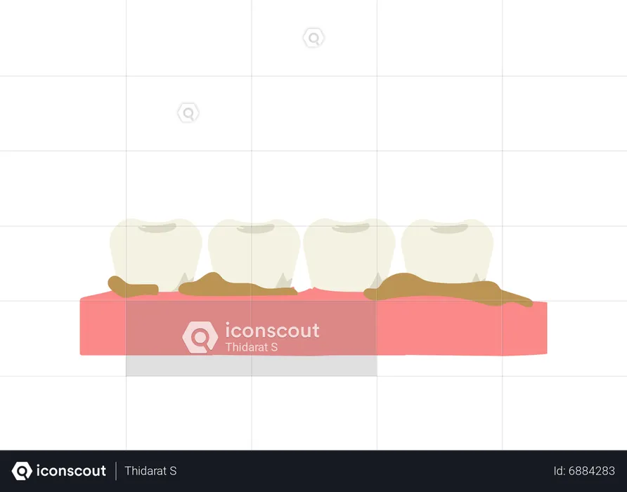 Plaque and tartar on the teeth  Illustration