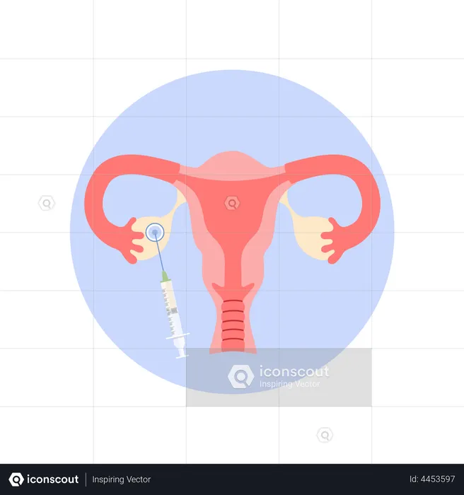 Removing oocyte from the ovary  Illustration