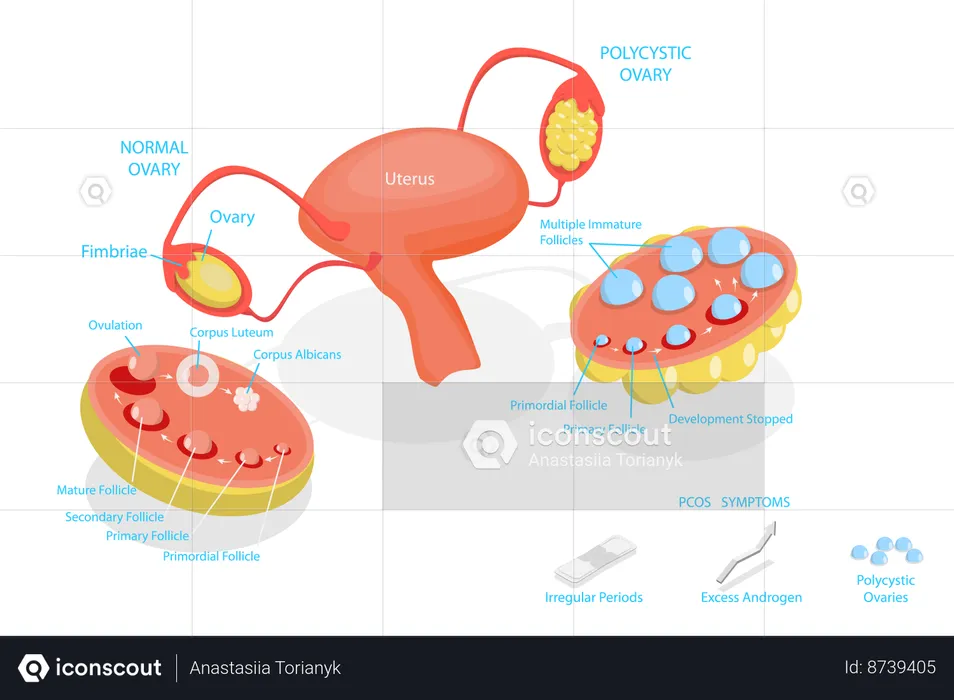 Syndrome des ovaires polykystiques  Illustration