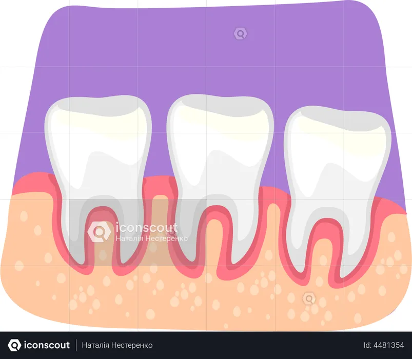 Teeth inflammation  Illustration
