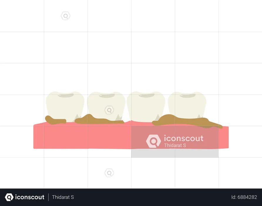 Teeth with plaque and tartar  Illustration