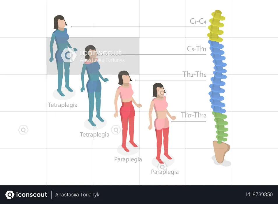 Tetraplegia And Paraplegia  Illustration