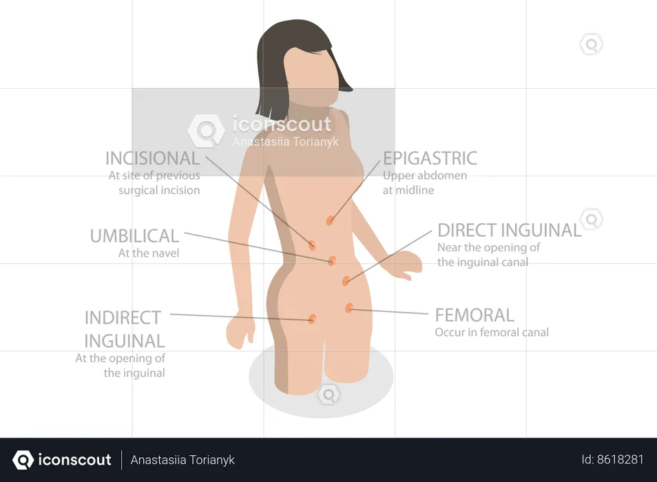 Type de hernie abdominale  Illustration