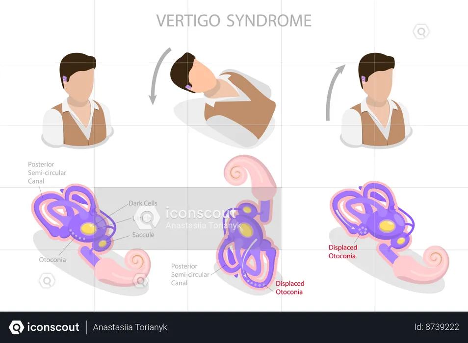 Vertigo Syndrome  Illustration