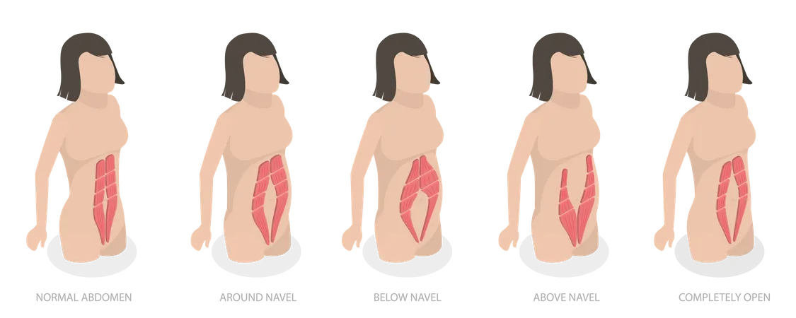 3 D Isometric Flat Vector Conceptual Illustration Of Abdominal Muscle Diastasis Women Probmlem After Pregnancy Illustration