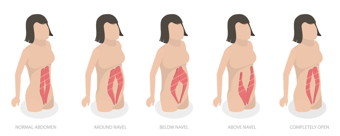 Abdominal Muscle Diastase and Women Problem After Pregnancy  Illustration