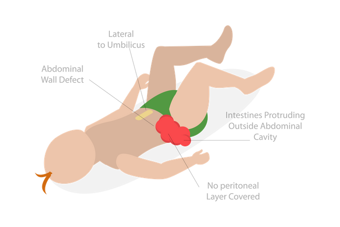 Abdominal pain belly button  Illustration