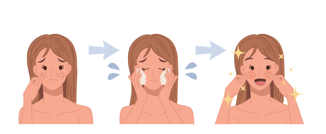 Acne treatment process for clear face  Illustration