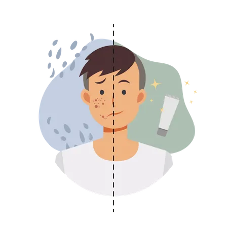 Acne treatments  Illustration