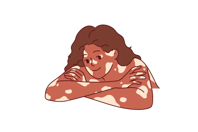 African American woman with vitiligo syndrome and spots on skin leaning elbows on white surface  Illustration
