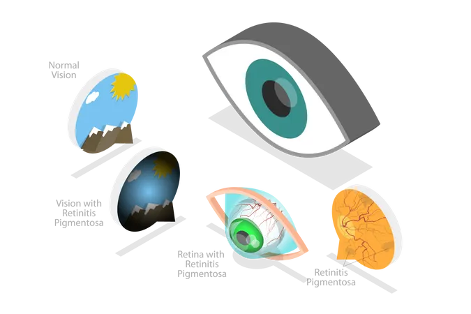 3 D Isometric Flat Vector Conceptual Illustration Of Retinal Degenerative Vision Age Related Macular Degeneration 일러스트레이션