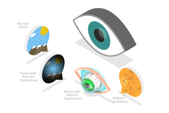 Age-Related Macular Degeneration  Illustration