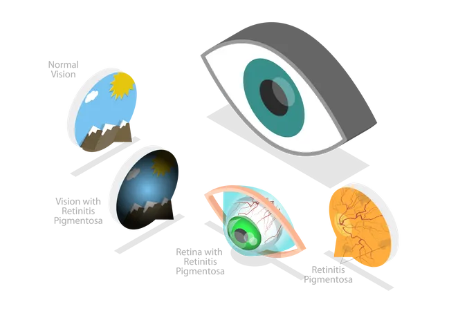 Age-Related Macular Degeneration  Illustration