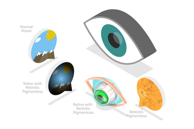 Age-Related Macular Degeneration  Illustration