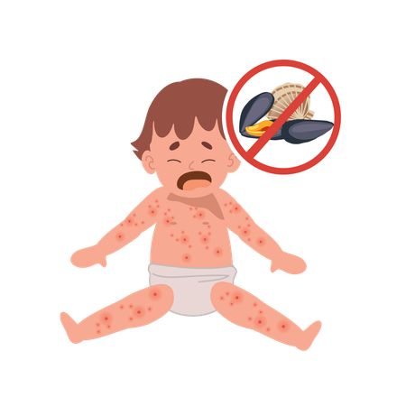 Allergic Reactions in Infants  Illustration