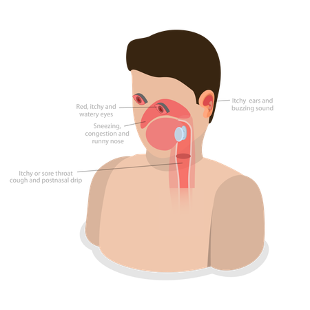 Allergic Rhinitis  Illustration