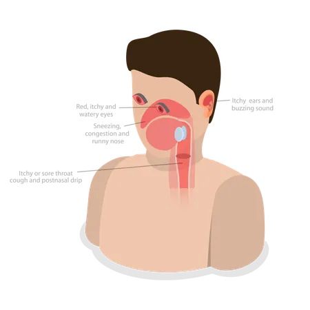 Allergic Rhinitis  Illustration