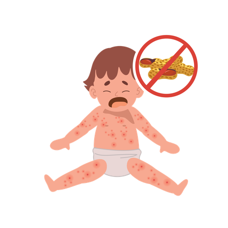 Allergie alimentaire pour bébé à l'arachide  Illustration