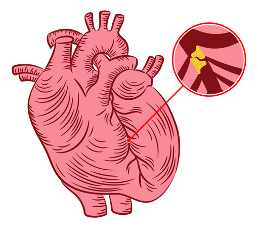 Arteriosklerose  Illustration