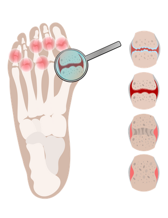 Arthrite des jambes, maladie rhumatoïde chronique  Illustration