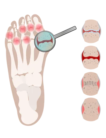 Arthrite des jambes, maladie rhumatoïde chronique  Illustration