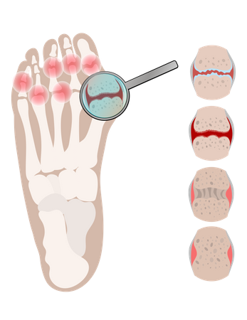 Arthritis Bein Rheumatoide chronische Krankheit  Illustration