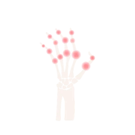 Arthritis Hand Rheumatoid Disease  Illustration