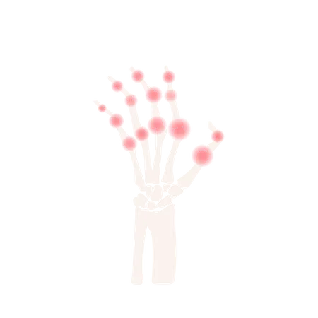 Arthritis Hand Rheumatoide Erkrankung  Illustration