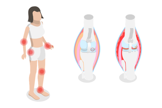 Arthrose et polyarthrite rhumatoïde  Illustration