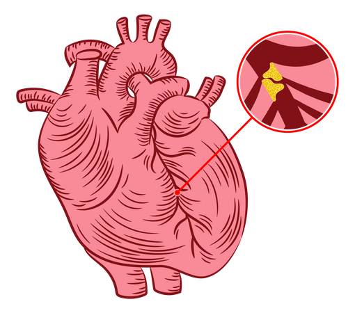 Aterosclerosis  Ilustración