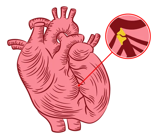 Athérosclérose  Illustration