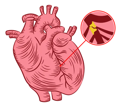 Atherosclerosis Illustration